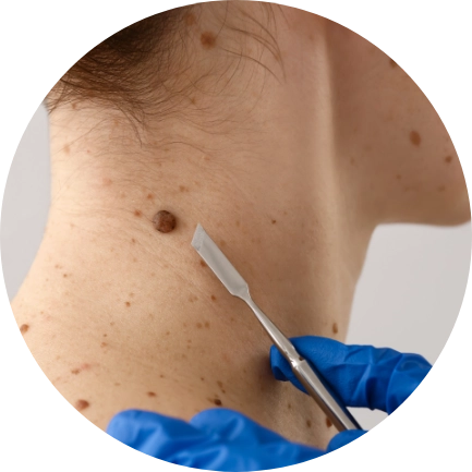 Mole Removal, BCC