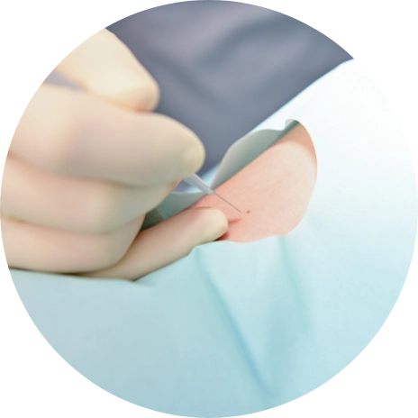 Benign Skin Lesion Treatment