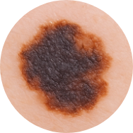 Melanoma