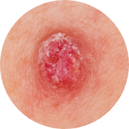 Squamous cell carcinoma (SCC)